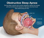 Sleep Apnea Treatment in New Jersey & NYC