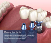 Dental Implants in NYC
