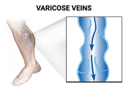 Varicose Veins Removal in Bronx NY