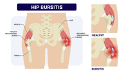 Hip Pain Treatment in Brooklyn