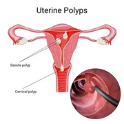 Endometrial Polyp Treatment in NYC